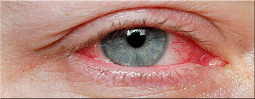 Contact Lenses Hygiene and Complications